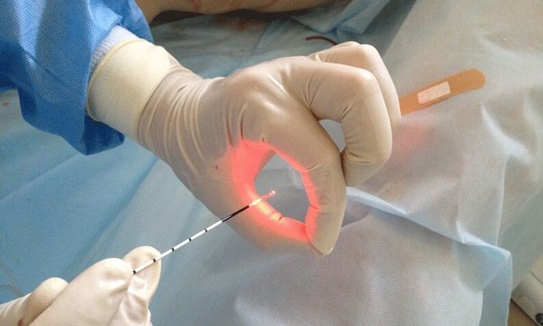 Traitement au laser pour la prostatite