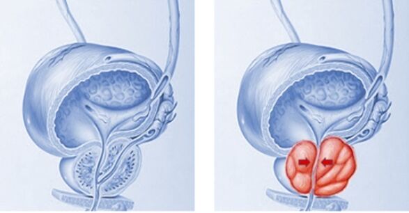 prostate saine et enflammée avec prostatite